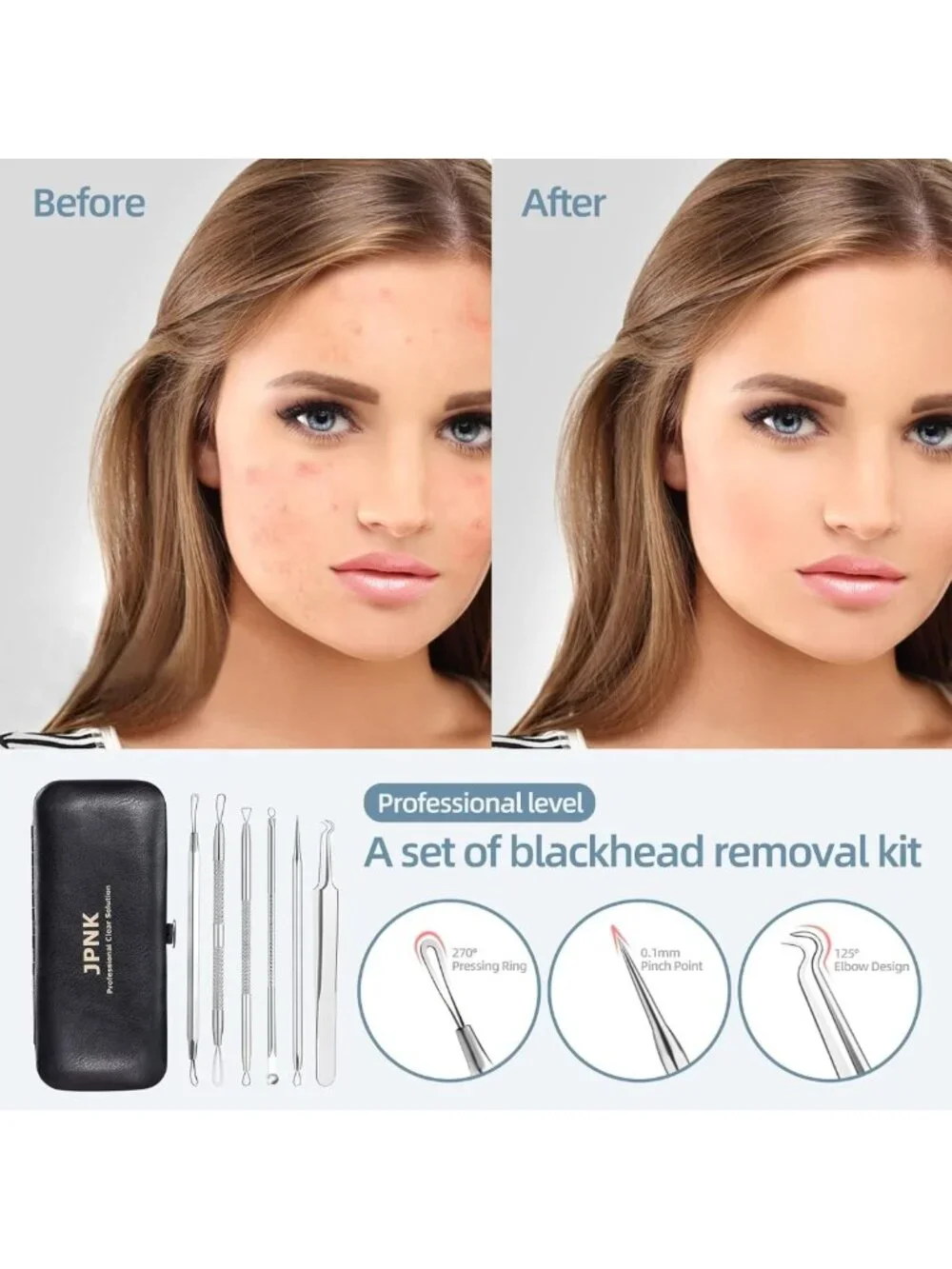 Effective Blackhead Remover Kit | Comedone Extractor for Acne Treatment & Clear